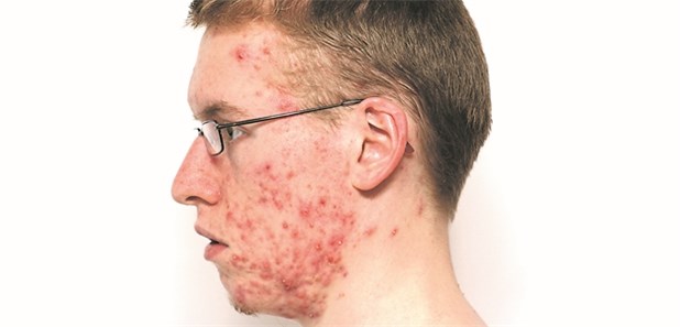 isotretinoin kaufen deutschland