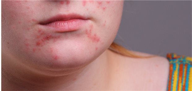 Akne belastet viele Jugendliche psychisch. Doch womöglich auch eine Behandlung mit Isotretinoin.