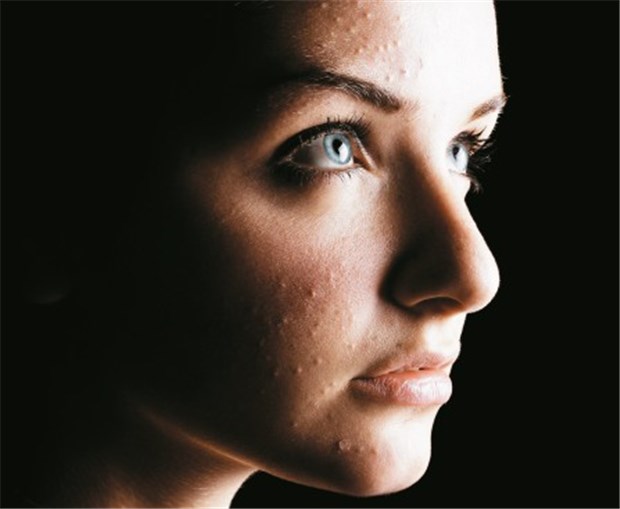 Patienten haben oft unrealistische Erwartungen an die Therapie Akne schädigt nicht nur die Haut, Akne nagt auch an der Seele.