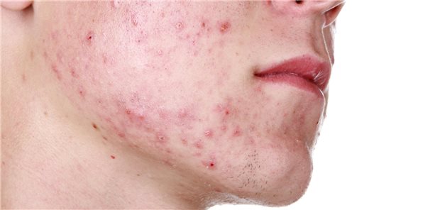 Nahaufnahme der rechten Wange eines Patienten mit Acne vulgaris.