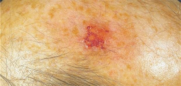 Aktinische Keratose: Eine konventionelle photodynamische Therapie ist für manche Patienten schmerzhaft.