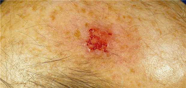 Aktinische Keratose: Eine rechtzeitige Behandlung kann die Entartung zum Hautkrebs aufhalten.