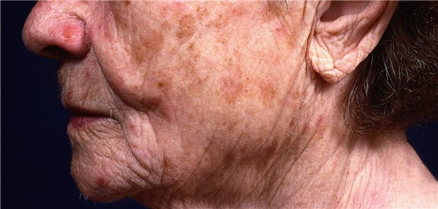 Aktinische Keratose: Tirbanibulin gilt zur Zeit als möglicher Kandidat für die Behandlung.