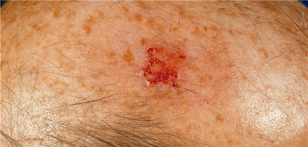 Aktinische Keratose: Was bedeutet dieser Befund langfristig? US-amerikanische Dermatologen sind dem jetzt nachgegangen.
