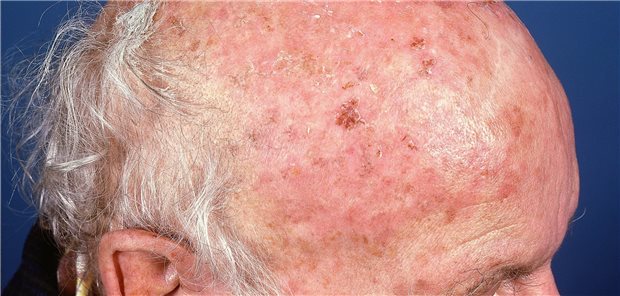 Aktinische Keratose der Kopfhaut. Betroffen von der Präkanzerose sind häufig Menschen, die sich berufsbedingt viel im Freien aufhalten. In der frisch aktualisierten S3-Leitlinie Hautkrebsprävention gibt es Tipps zur Vorbeugung.