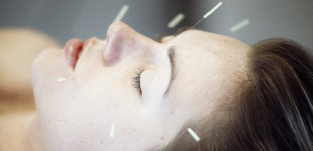Die Studie mit ein bisschen Wirkung Akupunktur am Kopf: Die Methode wird häufig bei chronischen Schmerzen angewandt.