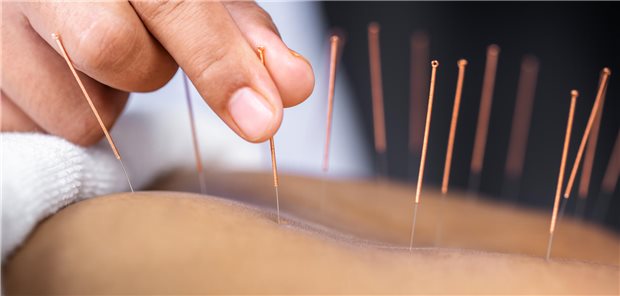 Akupunktur oder Massagen? Was von beiden wirksamer ist, hat ein US-amerikanisches Team nun untersucht. (Symbolbild)