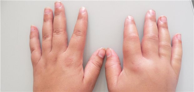 Akute Attacke bei einem Patienten mit hereditärem Angioödem: Die rechte Hand ist stark geschwollen.
