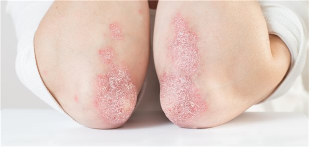 Ellenbogen eines Patienten mit akuter Psoriasis