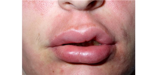 Akute Schwellungen im Gesicht – Folge einer Allergie oder ein hereditäres Angioödem? Die Therapien unterscheiden sich deutlich.