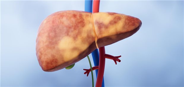 Alessandro Mantovani und Kollegen empfehlen, dass bei Betroffenen mit Hypothyreose mit hochgradigem Verdacht davon auszugehen sei, dass eine MASLD vorliegen könnte und dass diese Patienten ein erhöhtes Risiko für eine MASH oder eine fortgeschrittene Leberfibrose haben.