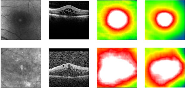 Algorithmus sagt die Netzhautdicke voraus. Von links nach rechts: Fundus-Bild, OCT-Bild, tatsächliche Netzhautdicke, vorhergesagte Netzhautdicke.