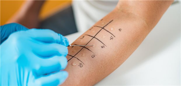 Immunologe führt Prick-Test mit Pilzallergenen am Arm einer Frau mit Asthma durch, um zu klären ob sie gegenüber bestimmten Pilzallergenen sensibilisiert ist.
