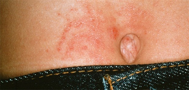 Allergisches Kontaktekzem im Nabelbereich, ausgelöst durch den nickelhaltigen Hosenknopf; die Erkrankung ist nicht IgE-vermittelt.