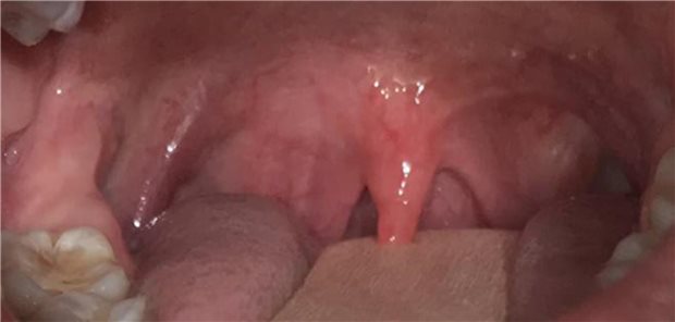 Einblick in den Rachenraum