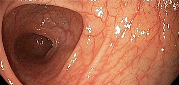 Alles sauber und ohne Krebsvorstufen? Koloskopie des Dickdarms.&#xA;