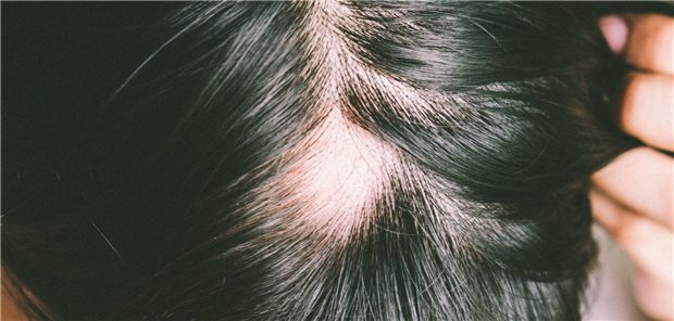 Alopecia areata (AA): In den vergangenen zwei Jahrzehnten war in den USA ein stetiger Anstieg der als Nebenwirkungen gemeldeten AA-Erkrankungen zu verzeichnen.
