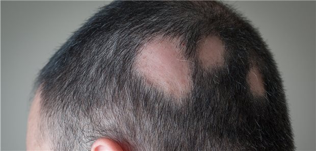 Alopecia areata: Bei Patienten mit kreisrundem Haarausfall könnte es sich lohnen, langfristig auf das Herz zu achten.
