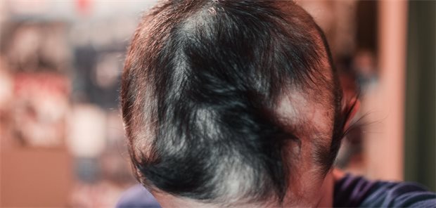 Person mit Alopecia areata