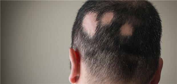 Alopecia areata: Es gibt weiter großen Bedarf an wirksamen und sicheren Therapien.