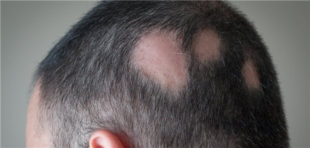 Alopecia areata beginnt typischerweise mit unregelmäßigen kahlen Stellen, kann aber auch zum kompletten Haarausfall führen.