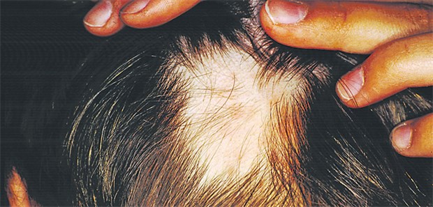 Eine Therapie reicht oft nicht Alopecia areata bei einer 21-jährigen Frau. Auch Augenbrauen und Wimpern können ausfallen.