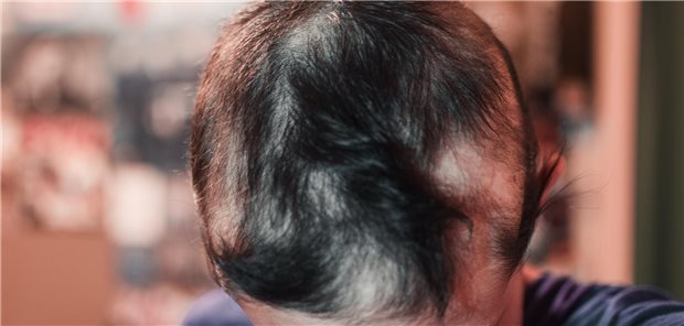 Junge mit stellenweisem Haarausfall.