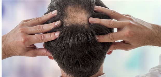 Alopezie: Forscher sind auf der intensiven Suche nach Therapien.