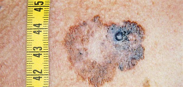 Erhöhtes Risiko für Zweittumor bei Ersterkrankung unter 40 Als Auslöser eines erneuten primären Melanoms sehen Forscher mehr die Sonne als die Gene.