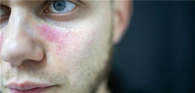 Mann mit „Schmetterlingsexanthem“ im Gesicht