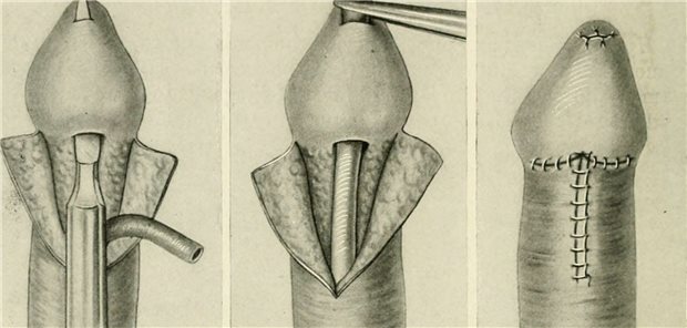 Alte Lehrbuchdarstellung der operativen Versorgung einer Hypospadie.
