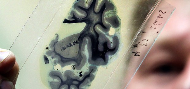 Antikörper bei Alzheimer gescheitert Alzheimer: Aus einem Antikörper wurde nichts.