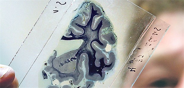 Nächster Versuch einer kausalen Therapie Alzheimer-Forschung: Eine neue Generation monoklonaler Antikörper steht in den Startlöchern.