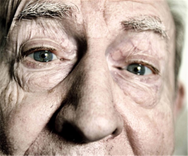 Neuer Test sagt Alzheimer voraus Alzheimer oder nicht? Mithilfe von Biomarkern kann eine Alzheimererkrankung vorhergesagt werden.