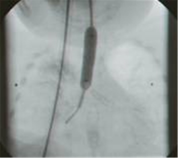 Trachealstent hilft Kindern mit Atemwegsstenose Am Ort der Atemwegsverengung wird der Stent mit einem Dilatationsballon entfaltet.