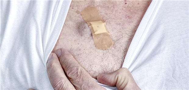 Abwertung kleiner Op – nach HNO-Ärzten schießen sich auch die Dermatologen ein Ambulante Op im EBM: Kleine Hautoperationen wurden abgestuft, dafür gibt es für größere Eingriffe mehr Punkte. Nach dem BVDD verschlechtert das die Versorgung der Patientinnen und Patienten nachhaltig.