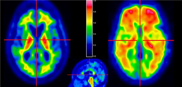 Neue GOP: 400 Euro für Erprobung der Amyloid-PET Amyloid-PET: links negativ, rechts positiv.