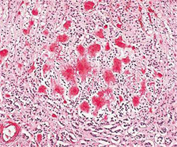 Alzheimer: Antikörper bremst Degeneration Amyloid-Plaques. Sie sollen mit einer Immuntherapie aufgelöst werden.