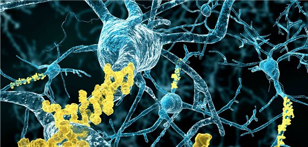 Amyloid-Plaques (gelb) auf Neuronen: ihre genaue Rolle bei der Entstehung der Alzheimerkrankheit bleibt weiterhin weitgehend offen.