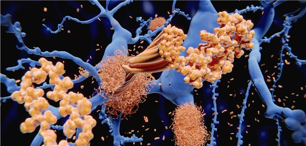 Amyloid-Plaques und -Fibrillen. Einen positiven Einfluss auf die Reduktion dieser Ablagerungen hatte Nilotinib in einer Studie.