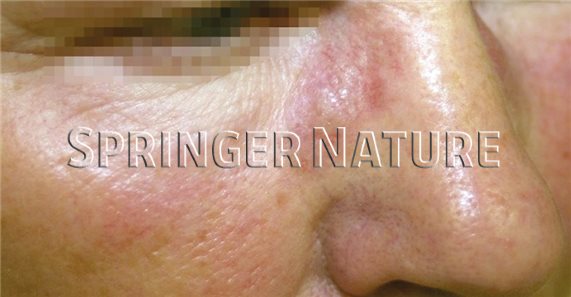 Schlecht sitzende Brille lÃ¶ste Granulome an der Nase aus