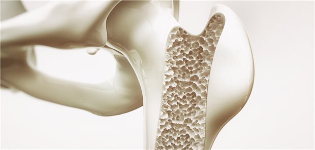 Dreidimensionale gerenderte Darstellung von Osteoporose (Stadium 4) im Oberschnekelknochen.