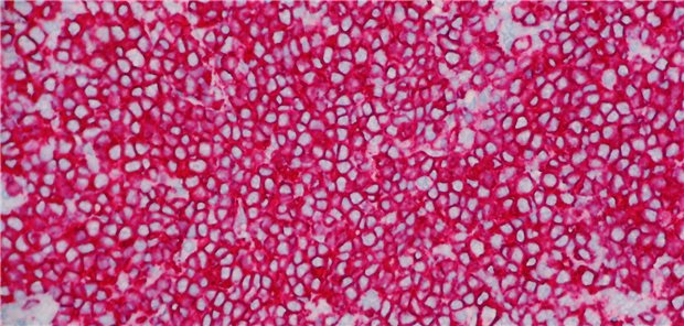 Mikroskopische Ansicht eines hochgradigen follikulären Lymphoms mit diffuser Membranexpression (rot) des B-Zell-Markers CD 20, bei der die Zellkerne hellblau erscheinen.