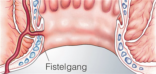 Analfistel: Unter Anästhesie werden die Stammzellen in einem Operationsumfeld appliziert.