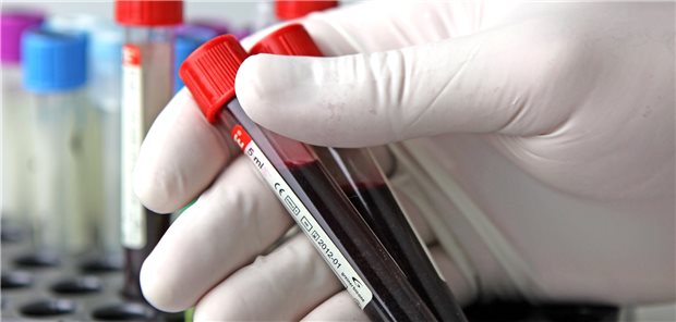 Analyse des Blutbildes: Risikofaktoren für eine Hyperkaliämie sind etwa eine chronische Nieren-Erkrankung oder Herzinsuffizienz.