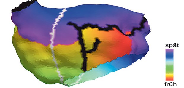 Anatomisches Modell des linken Vorhofs einer 70-jährigen Patientin. Schwarzer Bereich: bestehende Ablationsnarben der vorherigen Behandlung. Grauer Bereich: vom Algorithmus identifizierter Pfad, entlang dessen Vorhofflattern entstehen kann. Farbkodiert: klinisch gemessene Aktivierungszeit des aufgetretenen Vorhofflatterns.