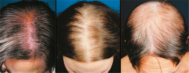 Haut und Haar altern bereits ab 30 Jahren Androgenetische Alopezie manifestiert sich bei Frauen anders als bei Männern entlang des Scheitels. © Springer Medizin Verlag