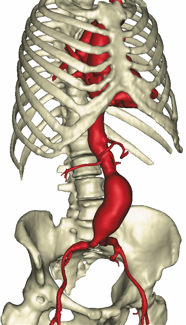Aneurysma der Bauchaorta ist ein leiser Killer Aneurysma der Bauchaorta.© © Prof. W.A. Wall, Lehrstuhl für Numerische Mechanik, TU München