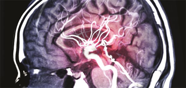 Aneurysma im Gehirn