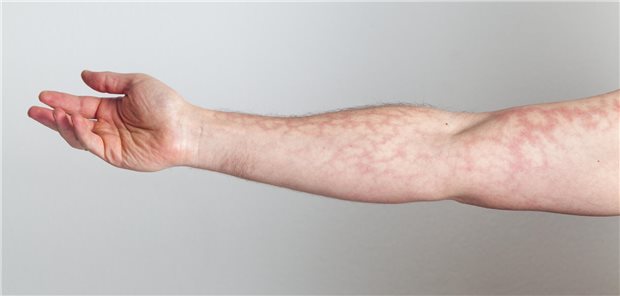 Männlicher, ausgestreckter rechter Arm mit rotem Hautkapillarnetz.